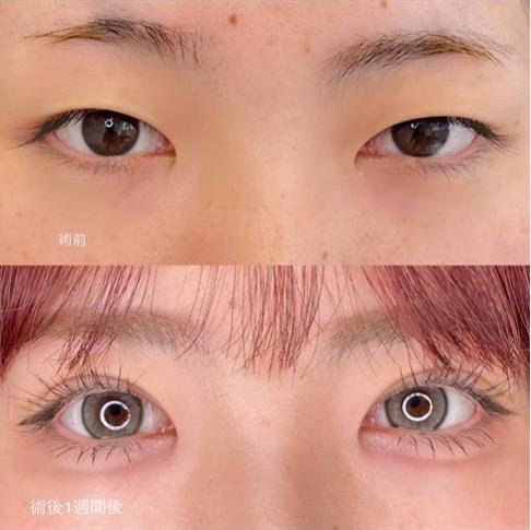 双眼皮手术