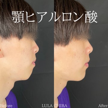 玻尿酸填充