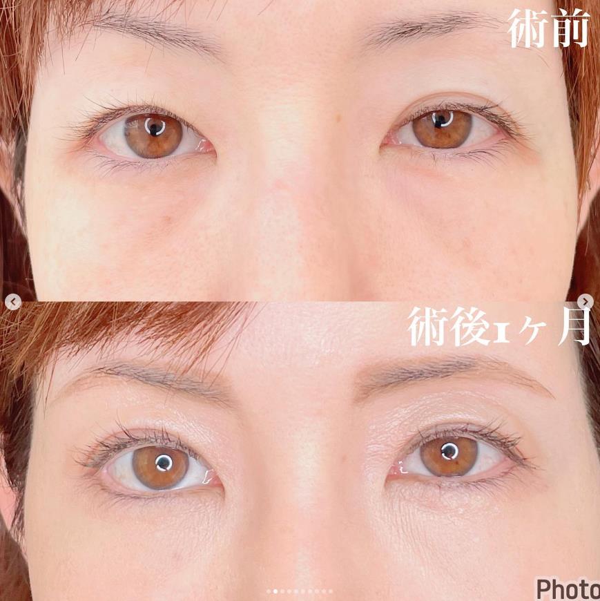 双眼皮手术