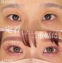 双眼皮手术