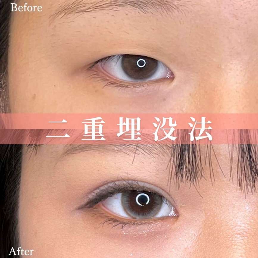双眼皮手术