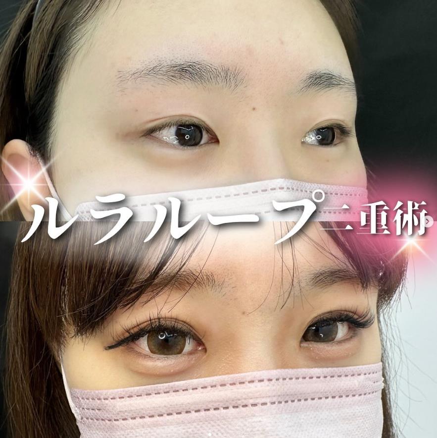 双眼皮手术