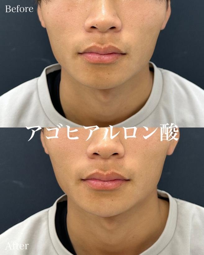玻尿酸填充