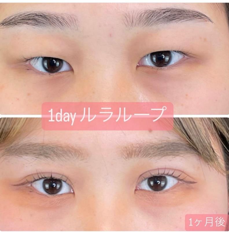 双眼皮手术