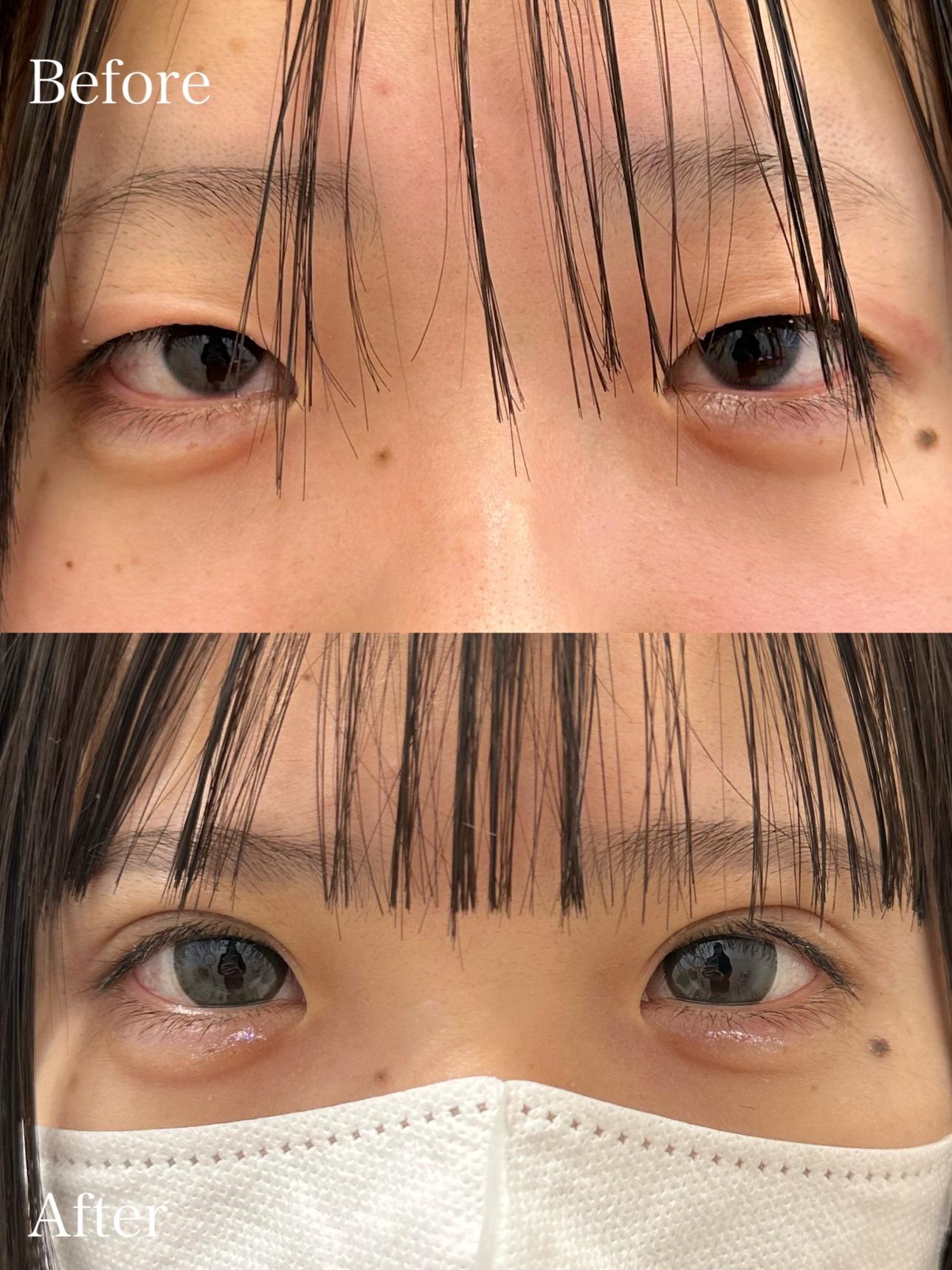 双眼皮手术
