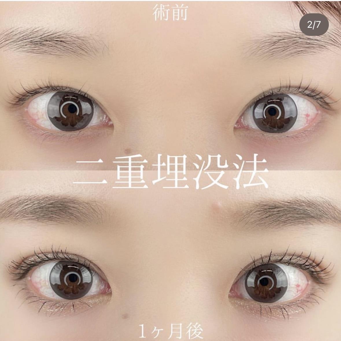 双眼皮手术