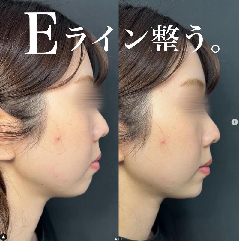 玻尿酸填充
