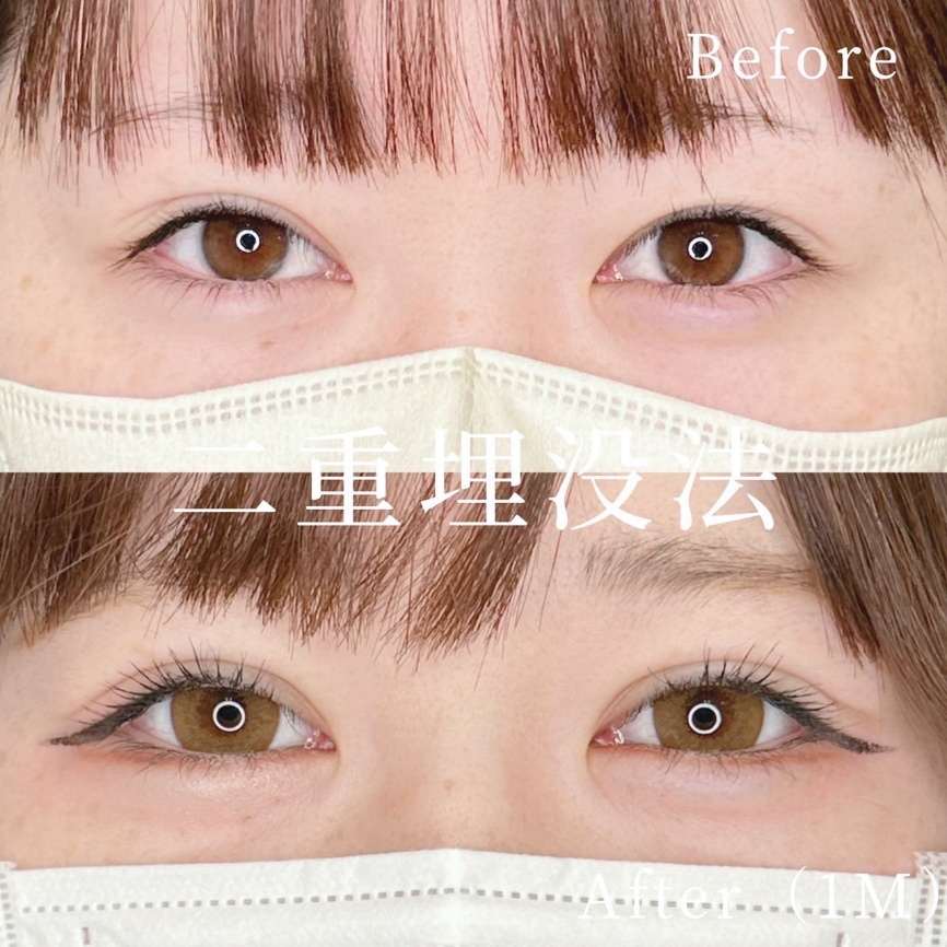 双眼皮手术