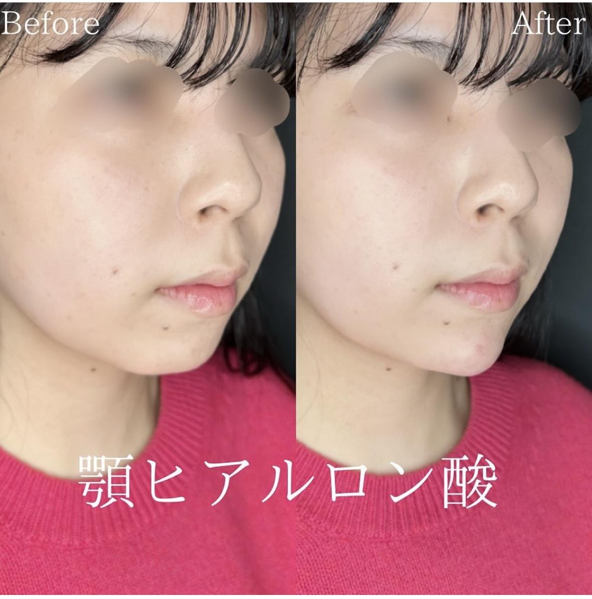 玻尿酸填充