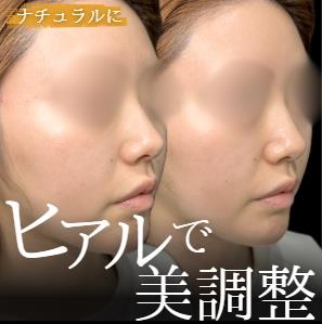 玻尿酸填充