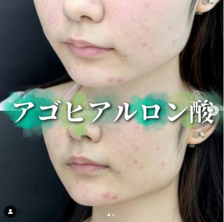 玻尿酸填充