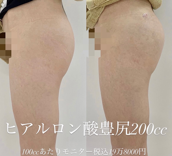 玻尿酸填充
