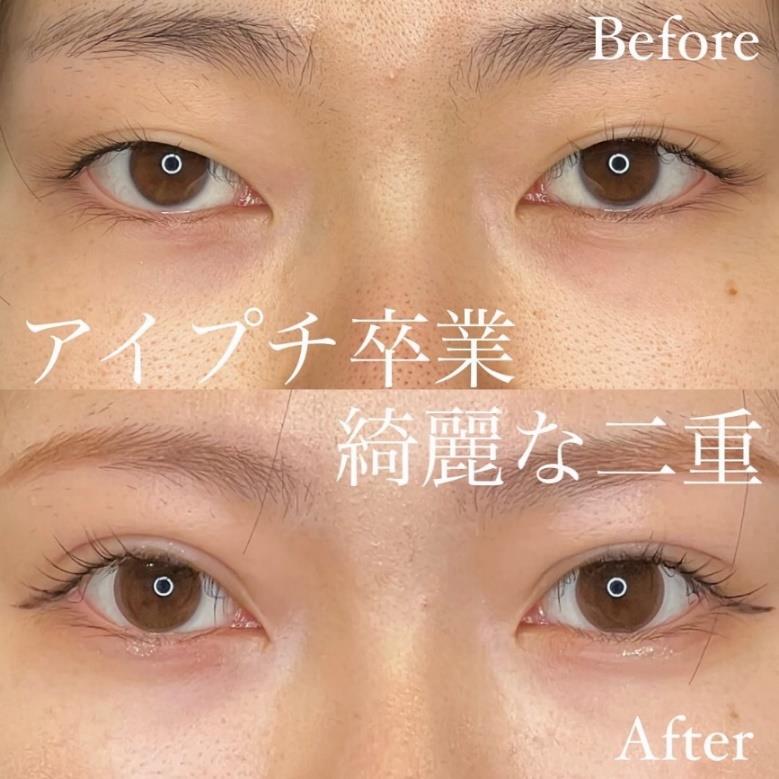 双眼皮手术