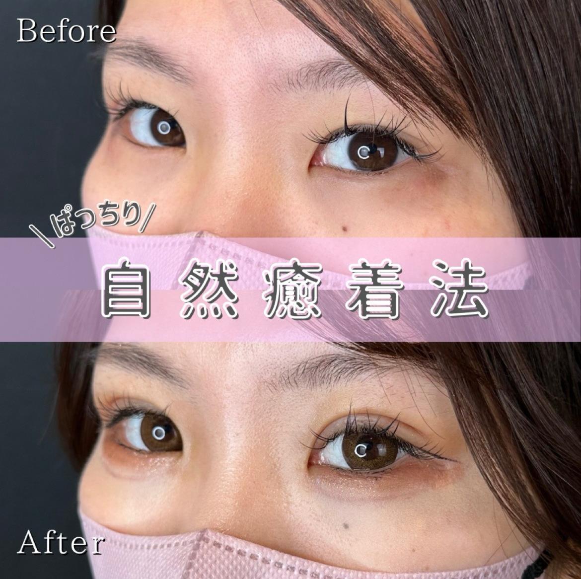 双眼皮手术