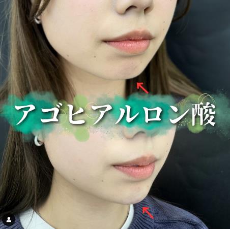 玻尿酸填充