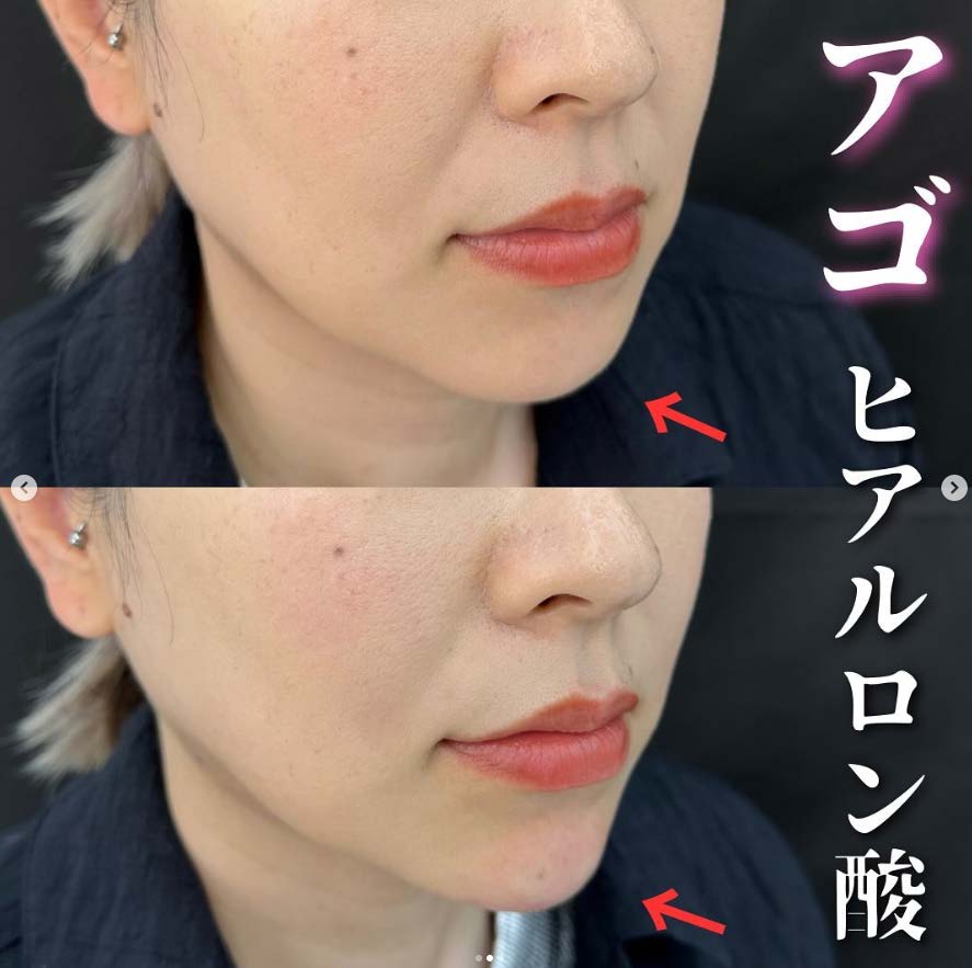玻尿酸填充