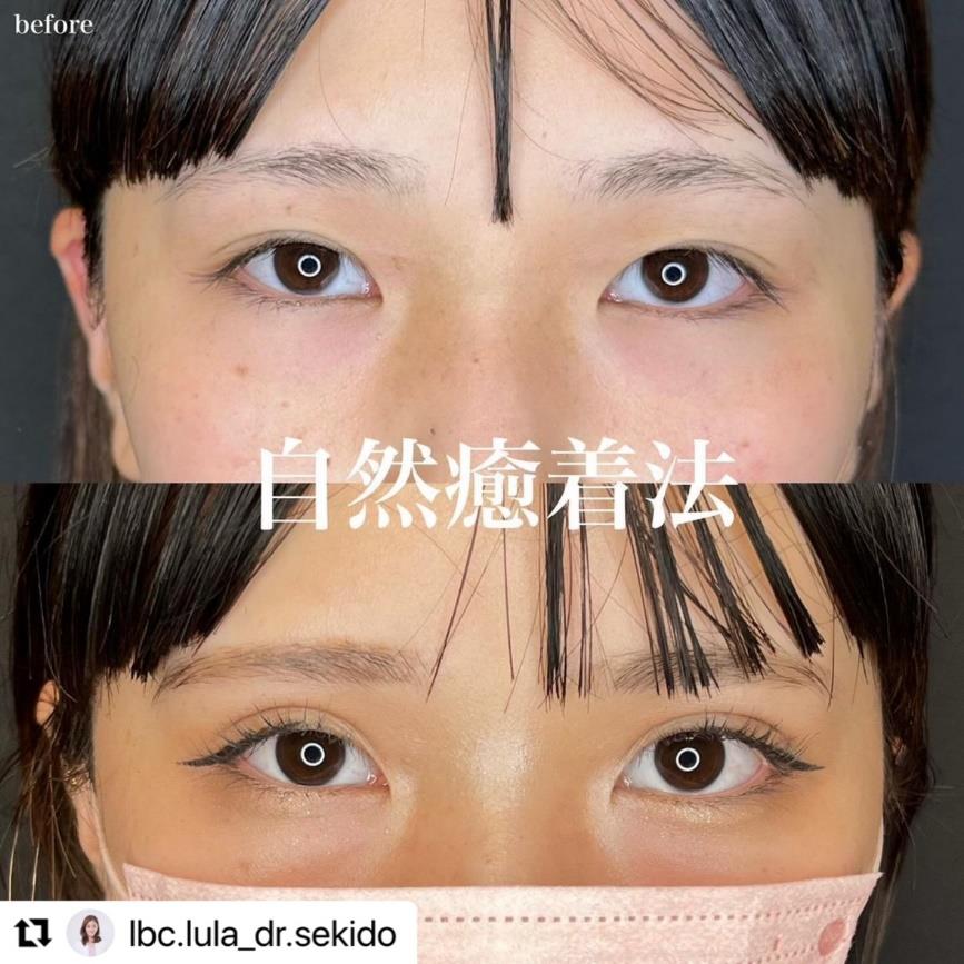 双眼皮手术