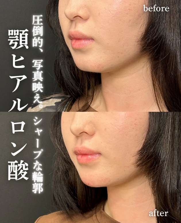 玻尿酸填充