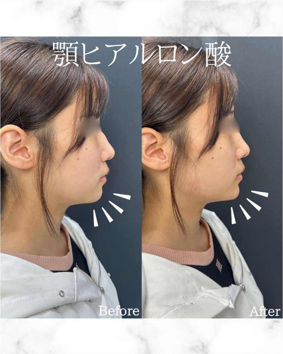 玻尿酸填充