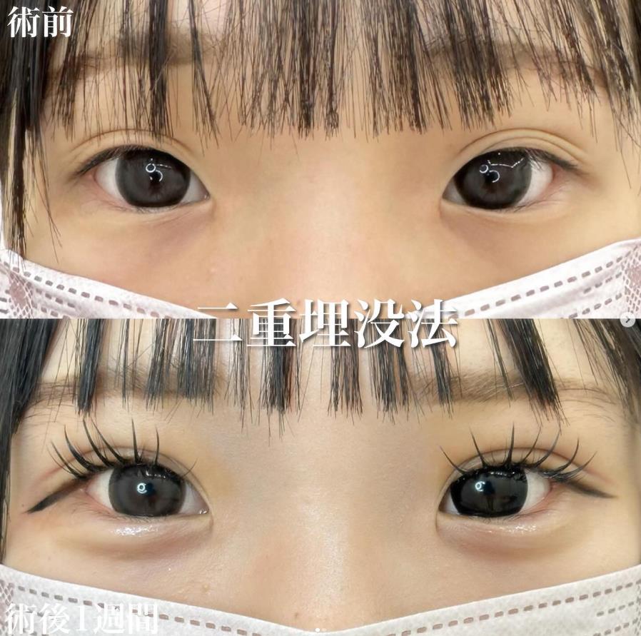 双眼皮手术