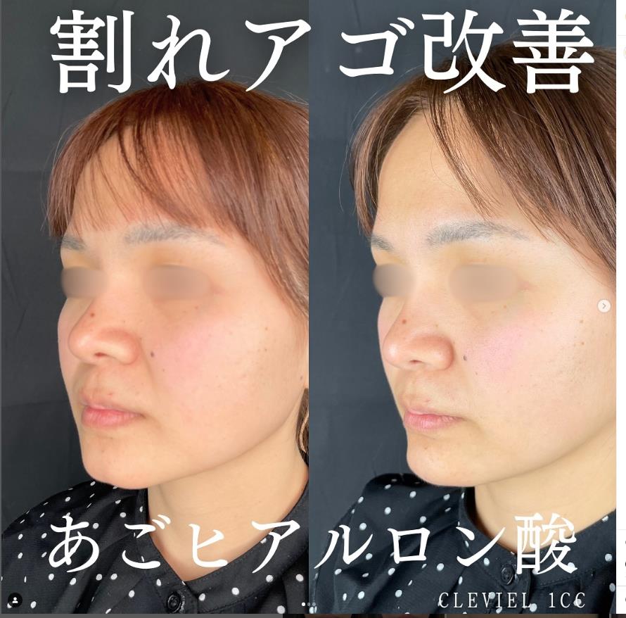 玻尿酸填充