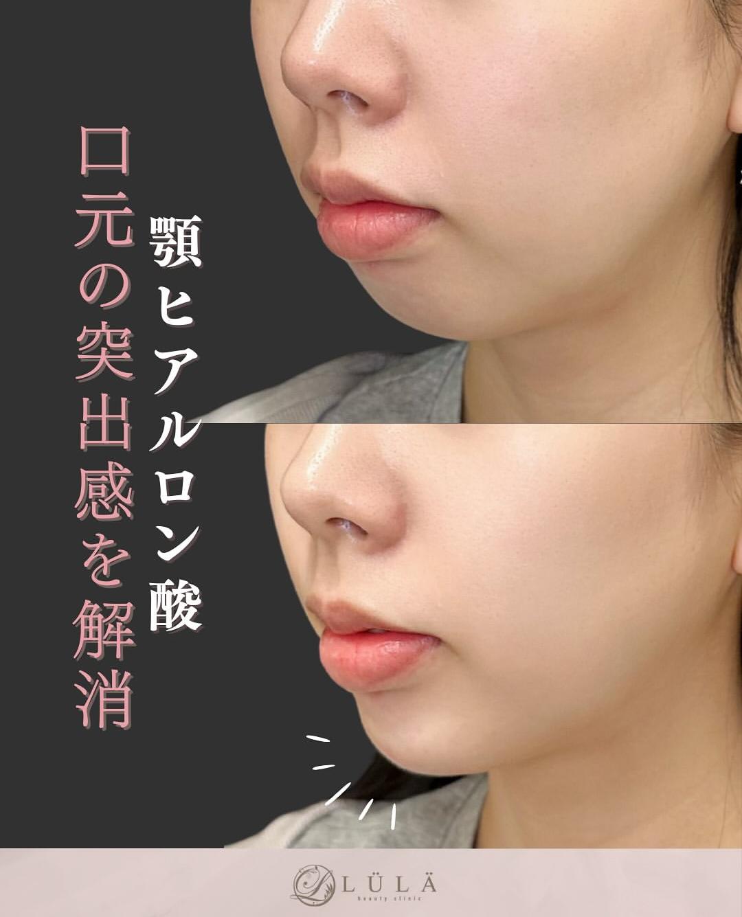 玻尿酸填充