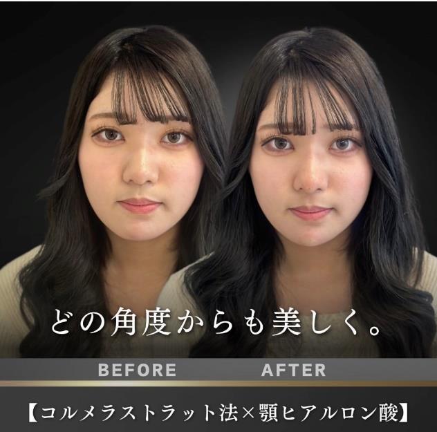 玻尿酸填充