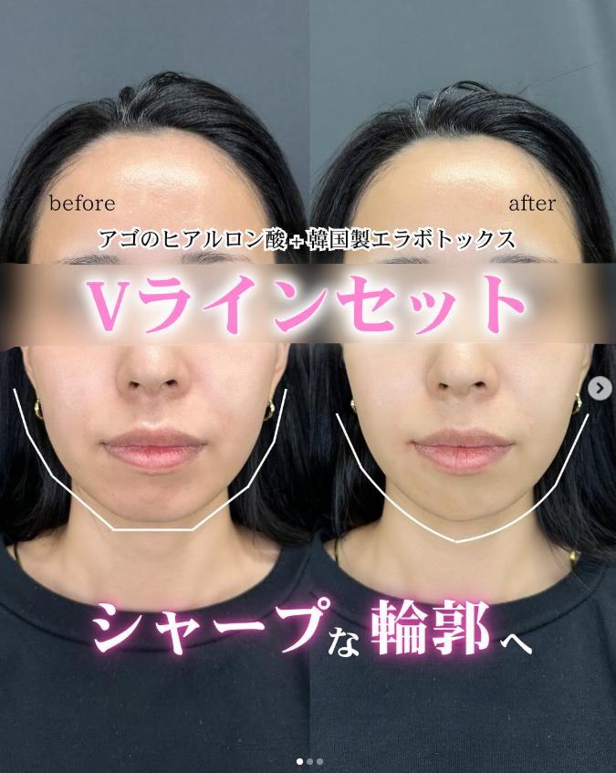 玻尿酸填充 + 咬肌瘦脸针