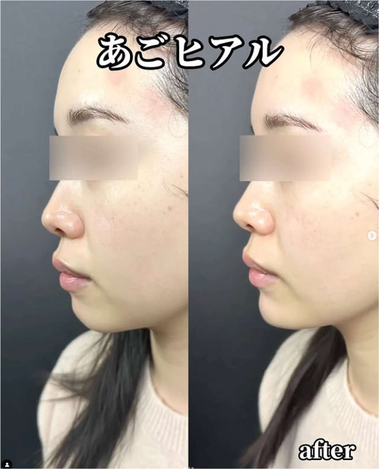 玻尿酸填充