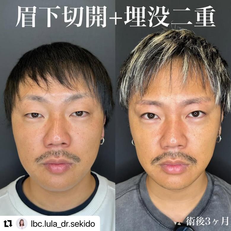 双眼皮手术