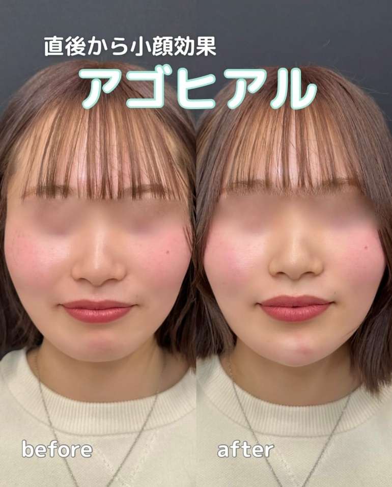 玻尿酸填充