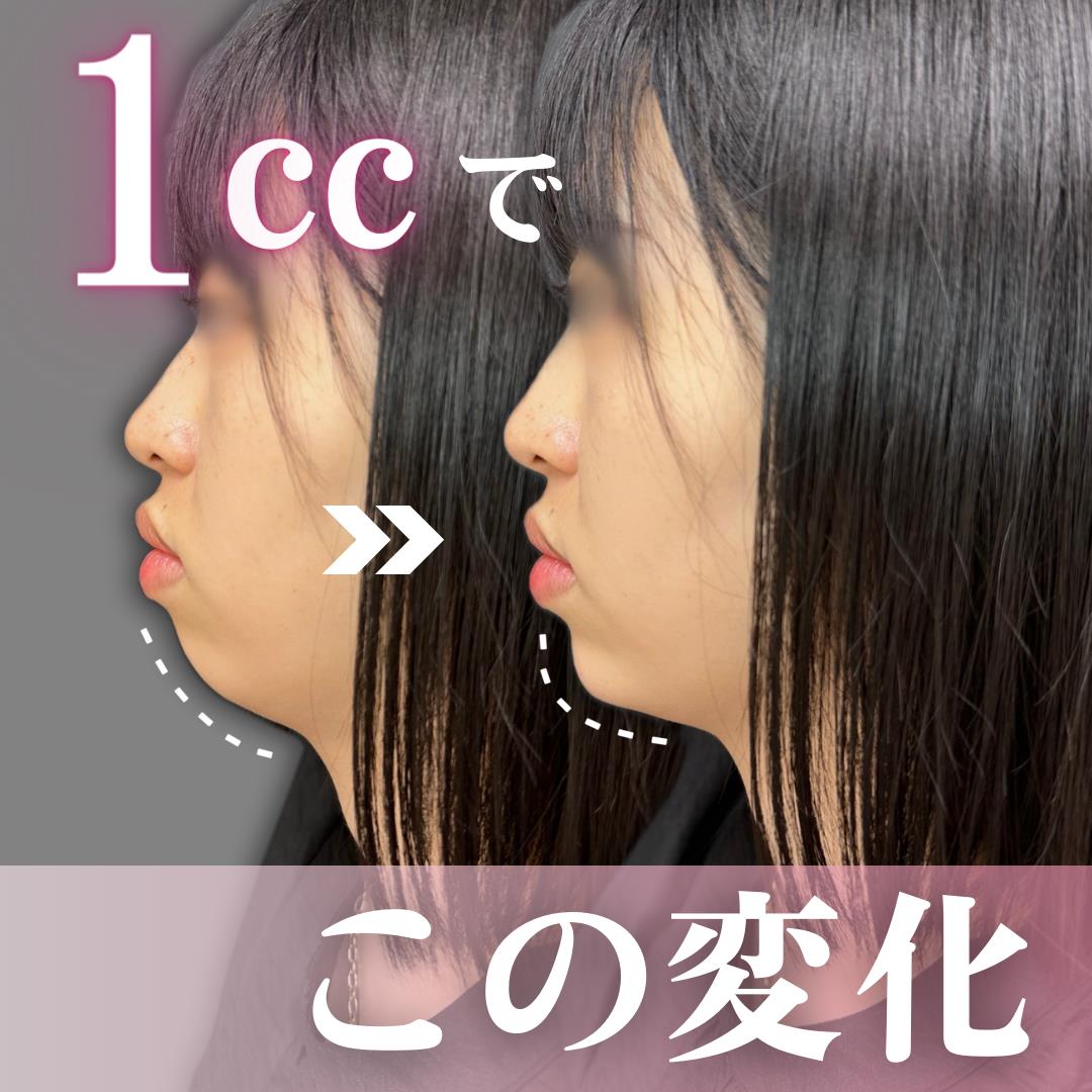 玻尿酸填充