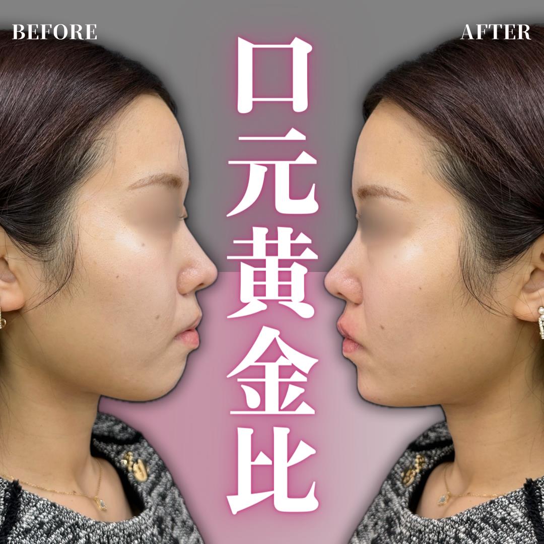 玻尿酸填充