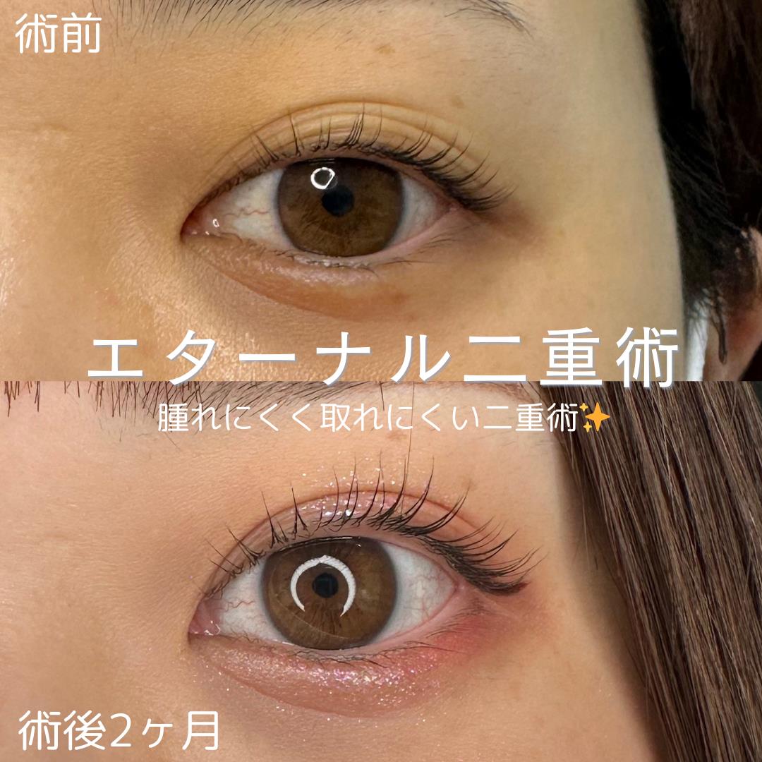 双眼皮手术