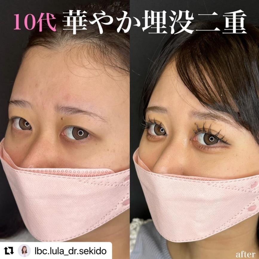 双眼皮手术