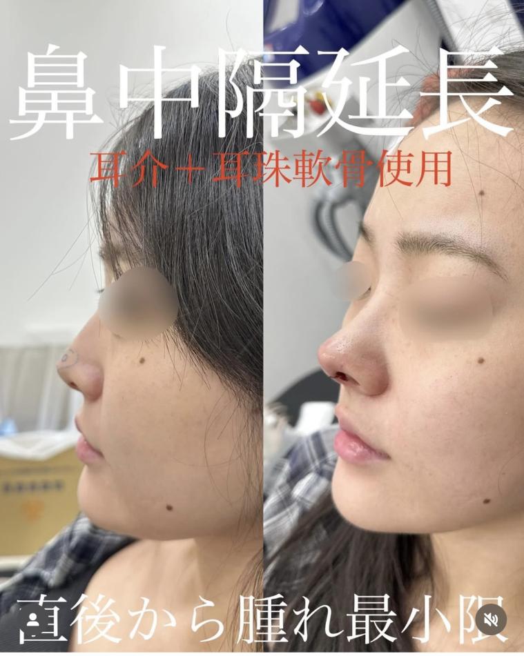 鼻综合整形 + 鼻尖整形 - 鼻中隔延长术