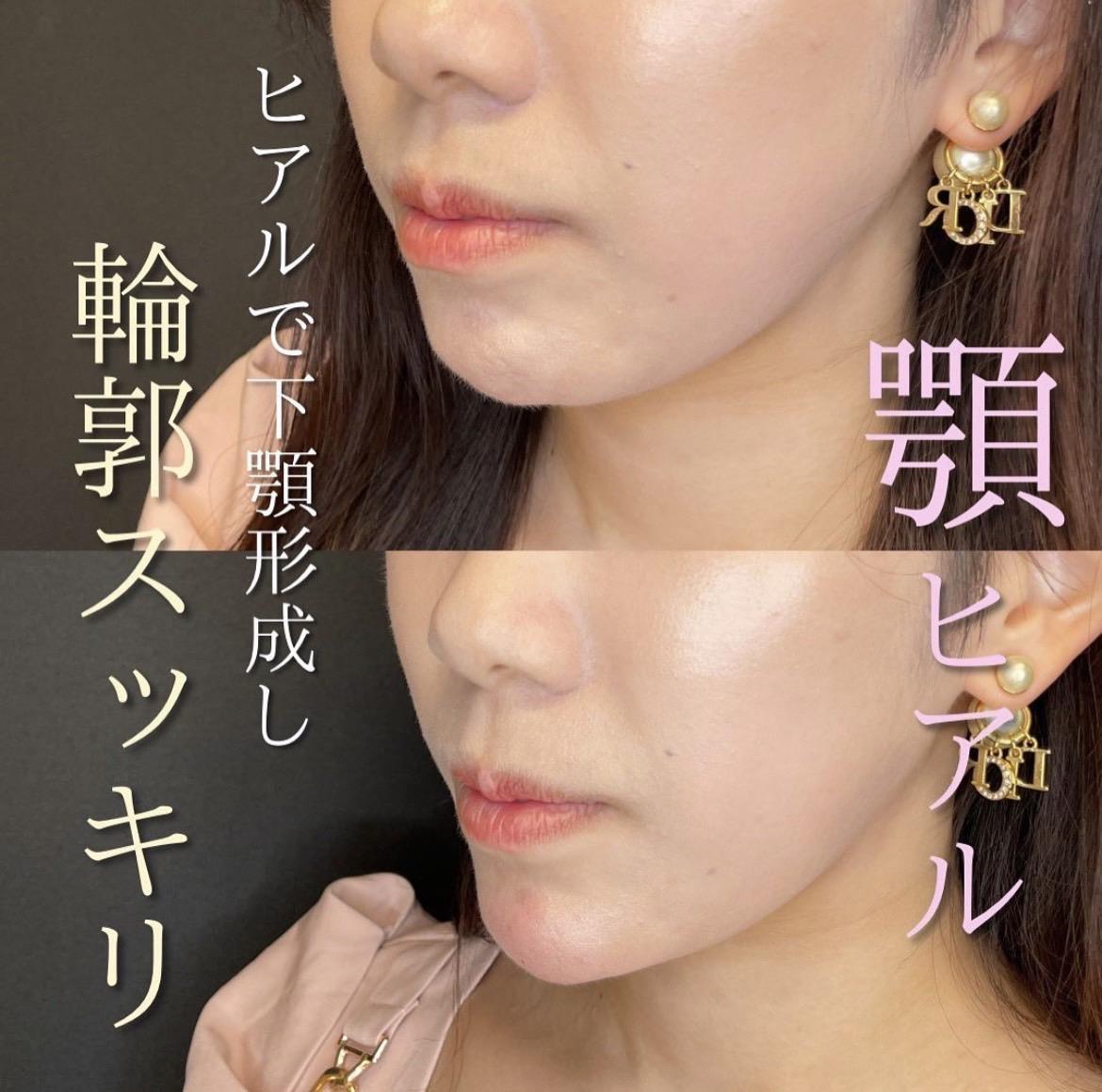 玻尿酸填充