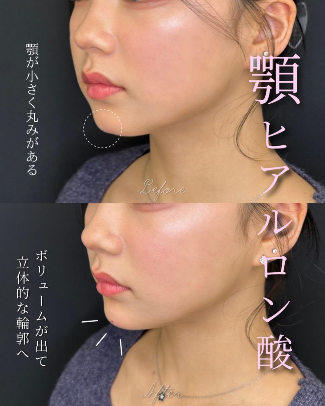 玻尿酸填充