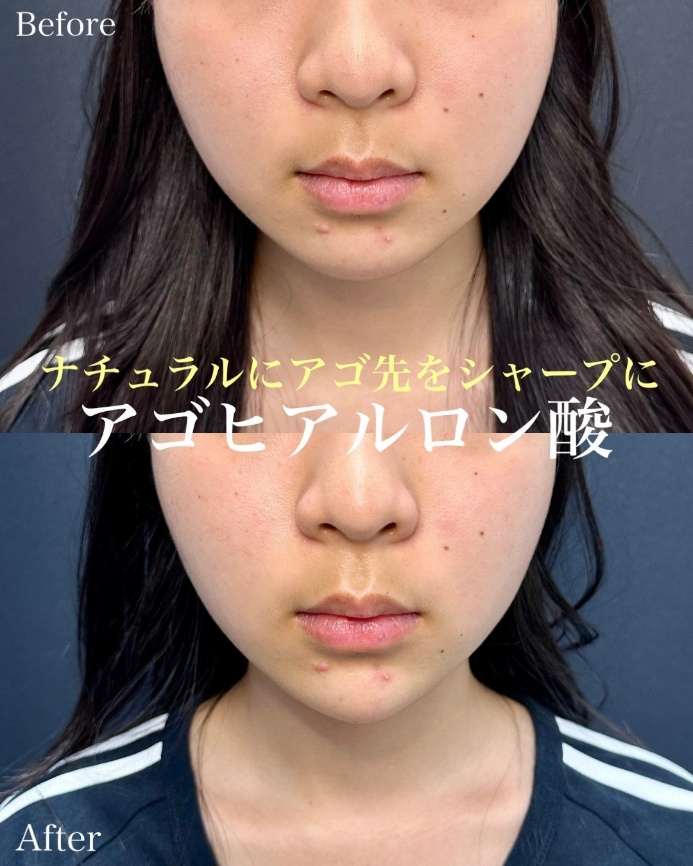 玻尿酸填充