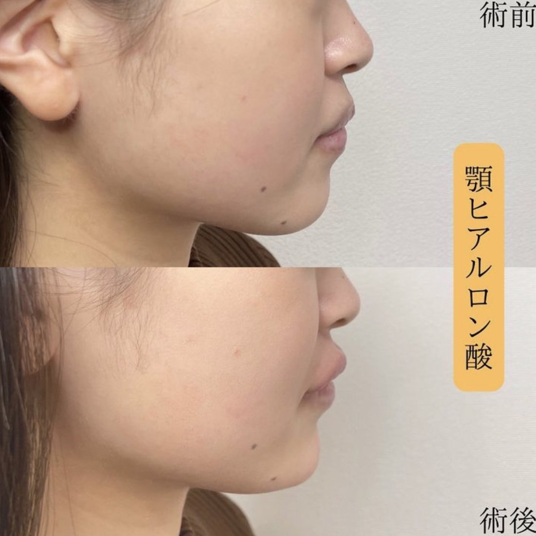 玻尿酸填充