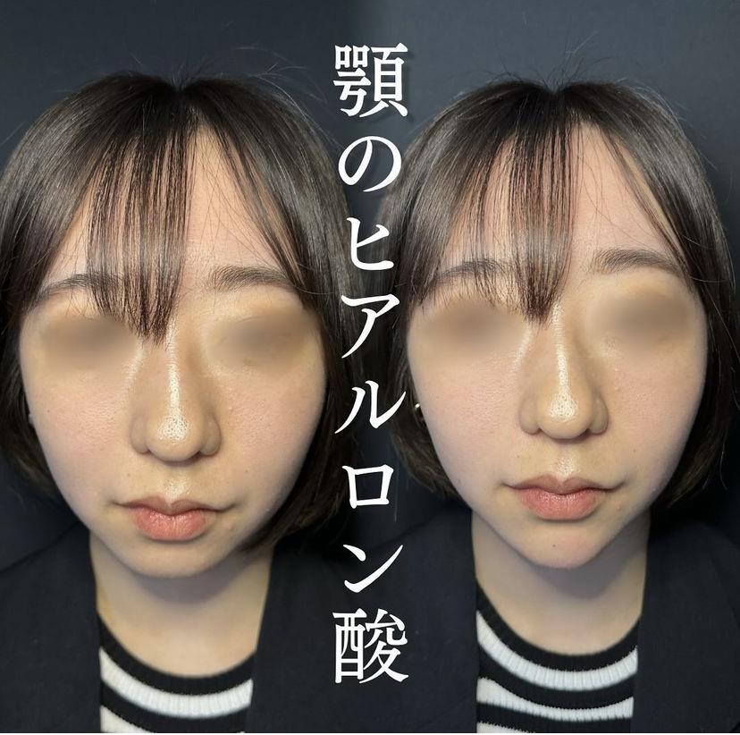玻尿酸填充
