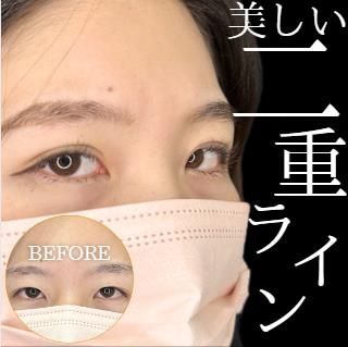 双眼皮手术