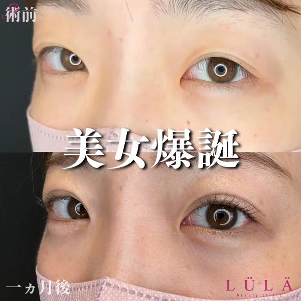 双眼皮手术