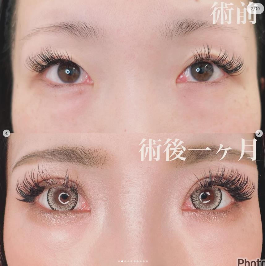 双眼皮手术