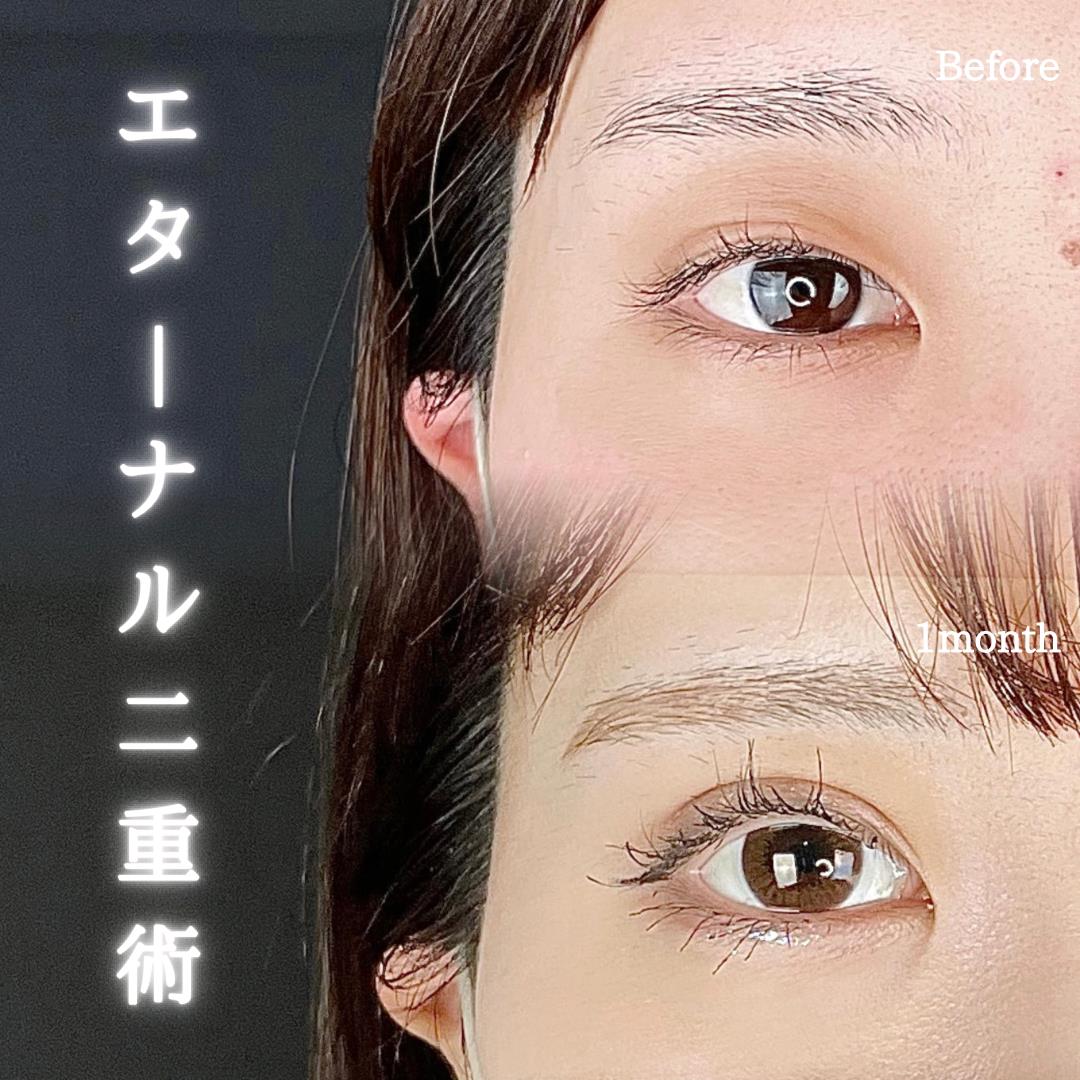 双眼皮手术