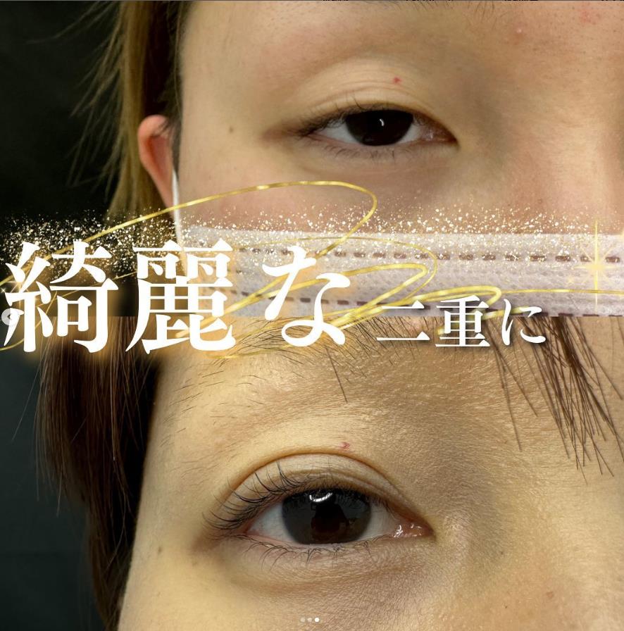 双眼皮手术