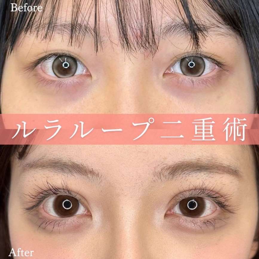 双眼皮手术