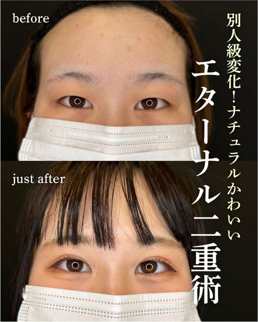 双眼皮手术