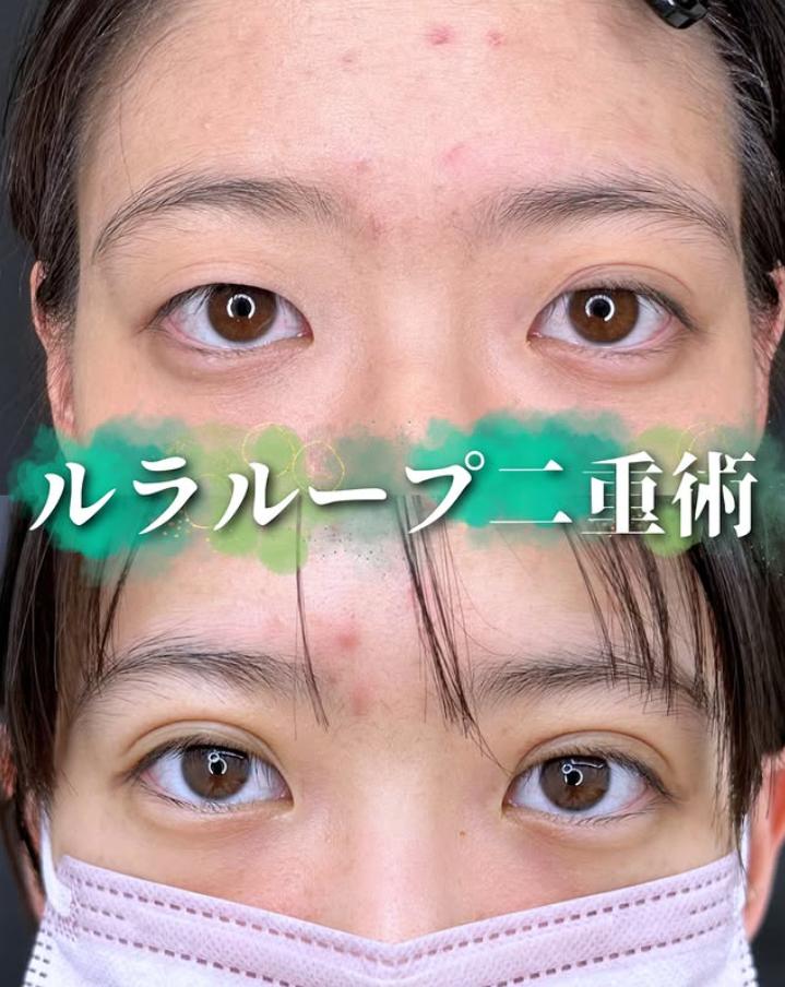 双眼皮手术