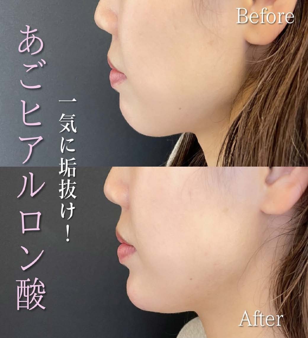 玻尿酸填充